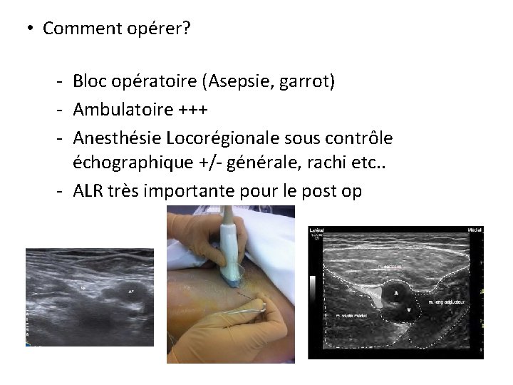  • Comment opérer? - Bloc opératoire (Asepsie, garrot) - Ambulatoire +++ - Anesthésie