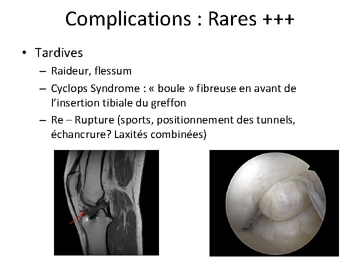 Complications : Rares +++ • Tardives – Raideur, flessum – Cyclops Syndrome : «