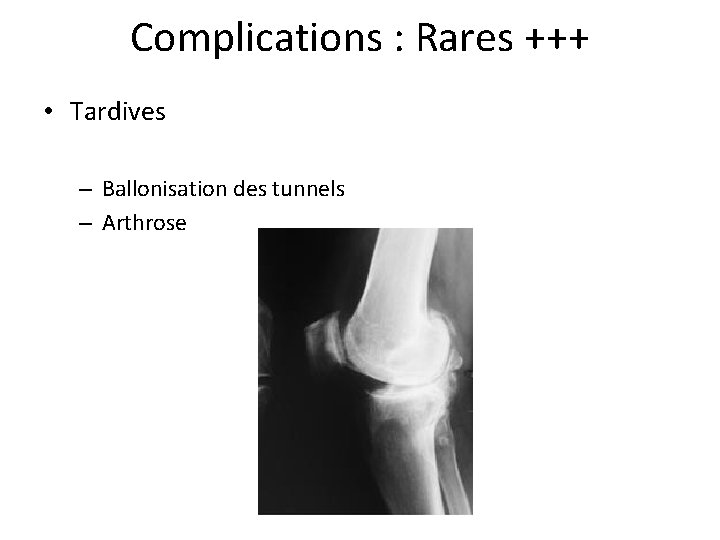 Complications : Rares +++ • Tardives – Ballonisation des tunnels – Arthrose 