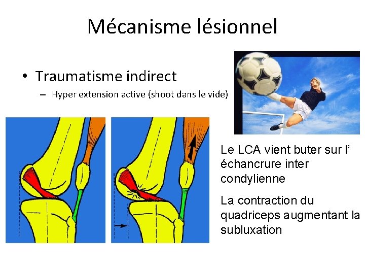 Mécanisme lésionnel • Traumatisme indirect – Hyper extension active (shoot dans le vide) Le