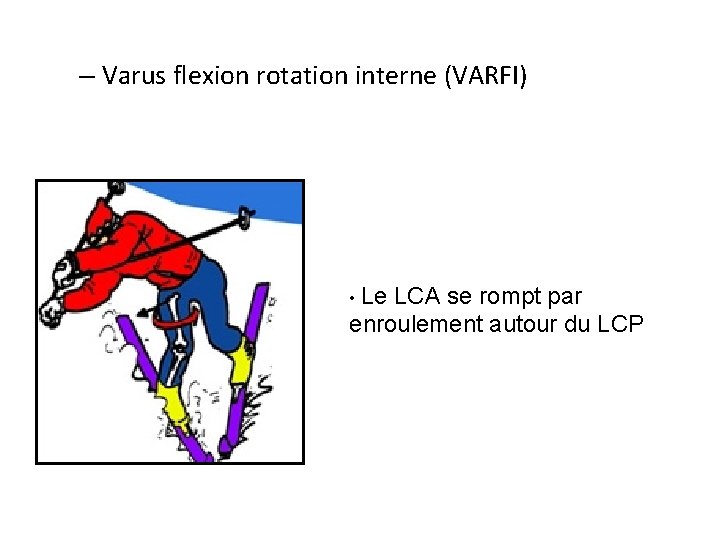 – Varus flexion rotation interne (VARFI) • Le LCA se rompt par enroulement autour