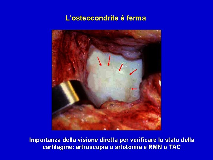 L’osteocondrite é ferma Importanza della visione diretta per verificare lo stato della cartilagine: artroscopia