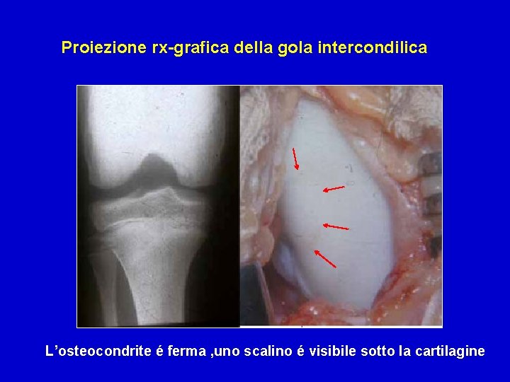 Proiezione rx-grafica della gola intercondilica L’osteocondrite é ferma , uno scalino é visibile sotto