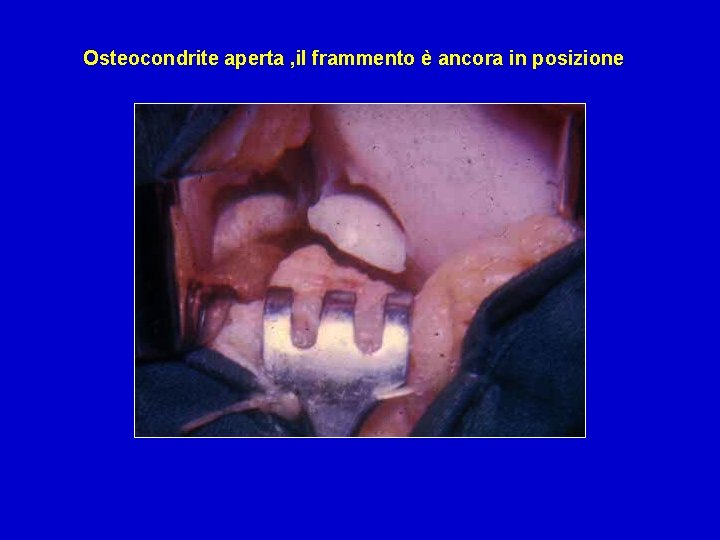 Osteocondrite aperta , il frammento è ancora in posizione 