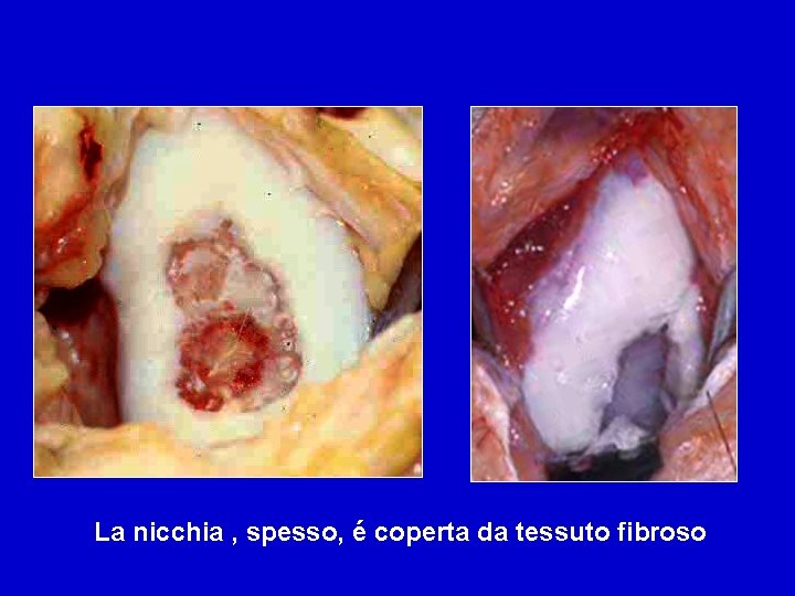 La nicchia , spesso, é coperta da tessuto fibroso 