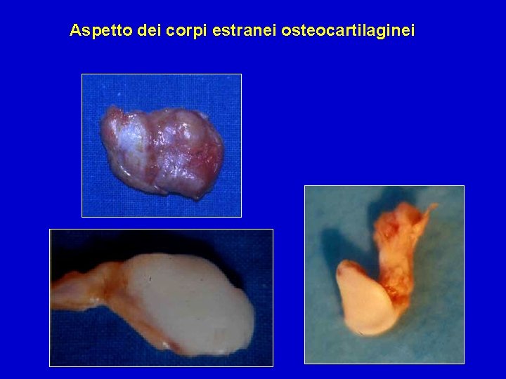 Aspetto dei corpi estranei osteocartilaginei 