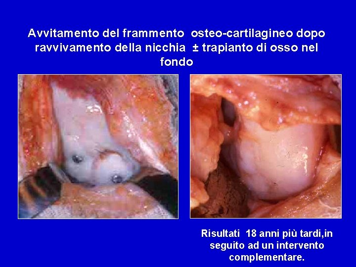 Avvitamento del frammento osteo-cartilagineo dopo ravvivamento della nicchia ± trapianto di osso nel fondo