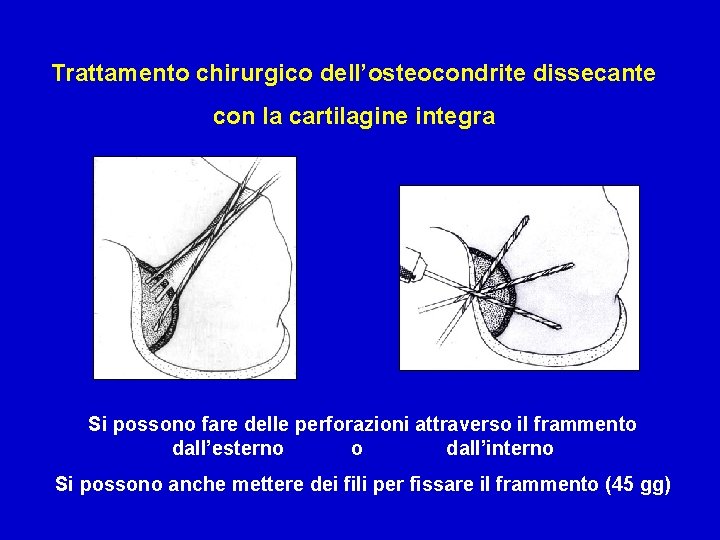 Trattamento chirurgico dell’osteocondrite dissecante con la cartilagine integra Si possono fare delle perforazioni attraverso