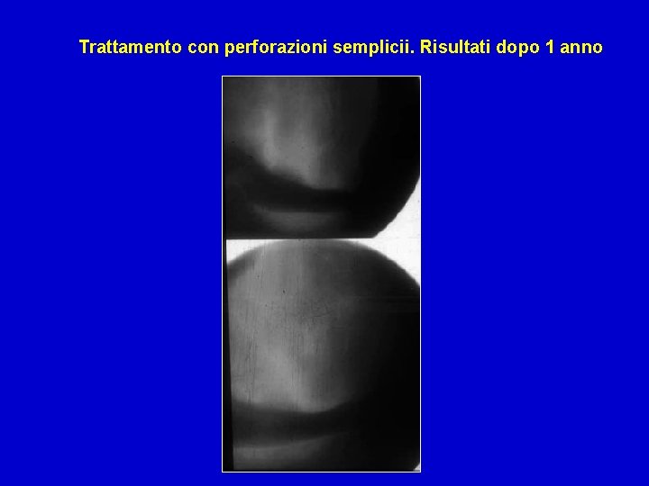 Trattamento con perforazioni semplicii. Risultati dopo 1 anno 