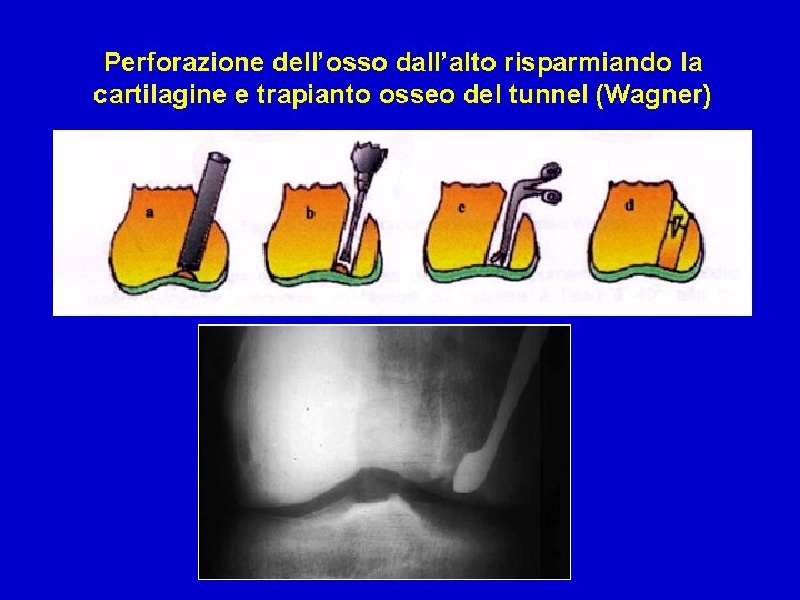 Perforazione dell’osso dall’alto risparmiando la cartilagine e trapianto osseo del tunnel (Wagner) 