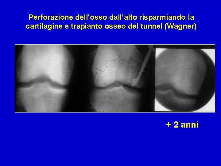 Perforazione dell’osso dall’alto risparmiando la cartilagine e trapianto osseo del tunnel (Wagner) + 2