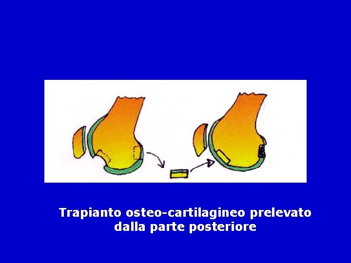 Trapianto osteo-cartilagineo prelevato dalla parte posteriore 