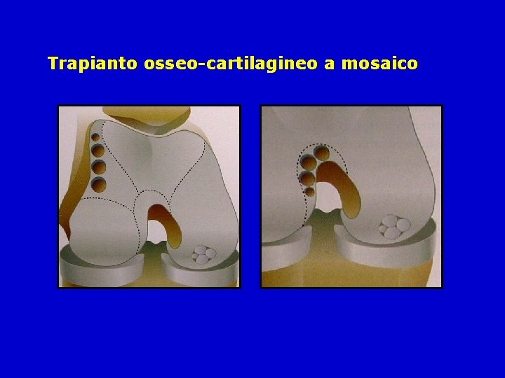 Trapianto osseo-cartilagineo a mosaico 