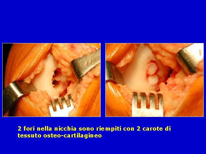 2 fori nella nicchia sono riempiti con 2 carote di tessuto osteo-cartilagineo 