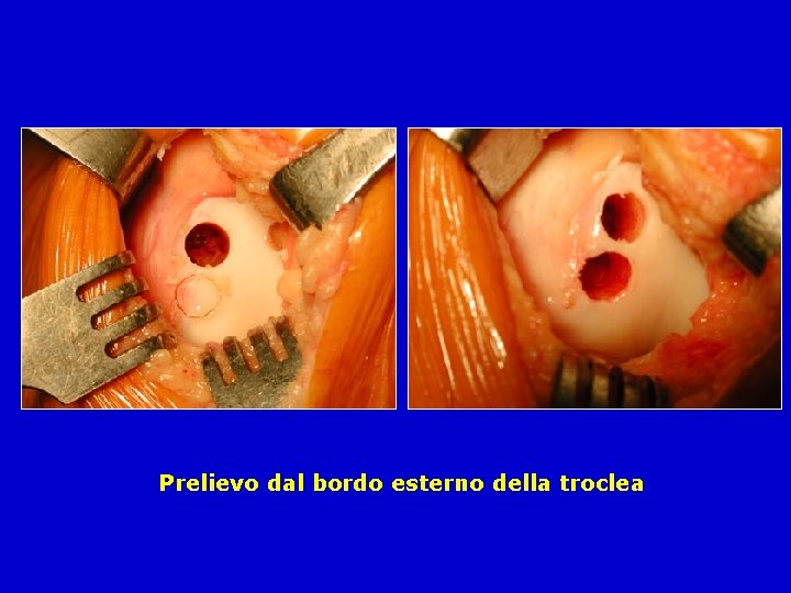 Prelievo dal bordo esterno della troclea 