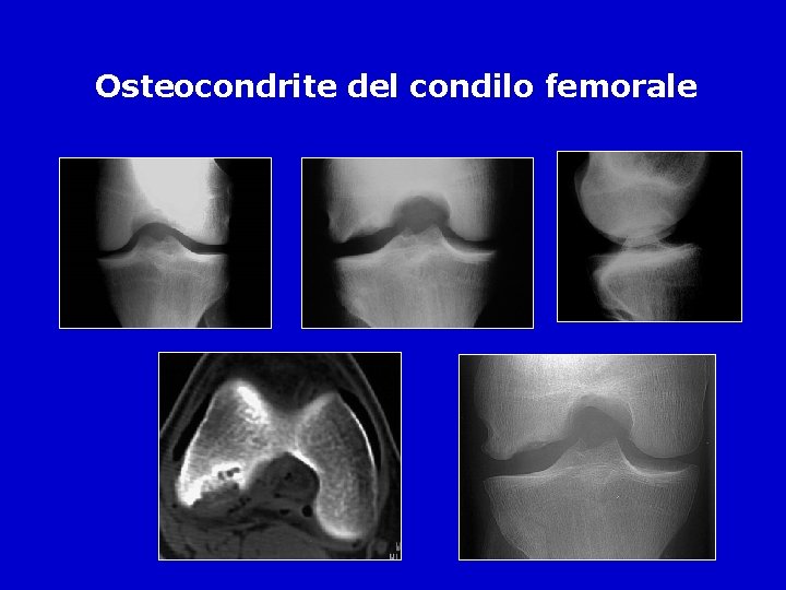 Osteocondrite del condilo femorale 