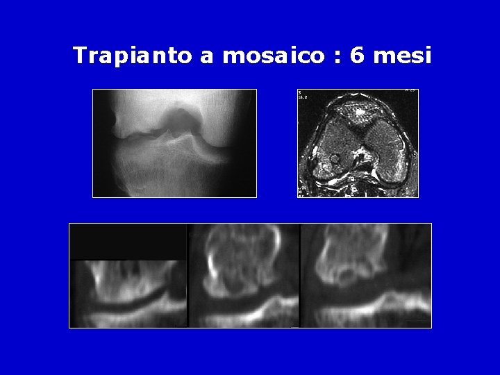 Trapianto a mosaico : 6 mesi 