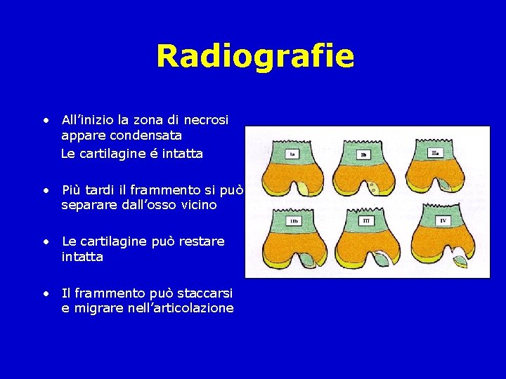 Radiografie • All’inizio la zona di necrosi appare condensata Le cartilagine é intatta •