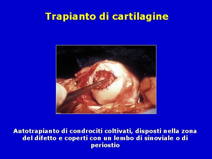 Trapianto di cartilagine Autotrapianto di condrociti coltivati, disposti nella zona del difetto e coperti
