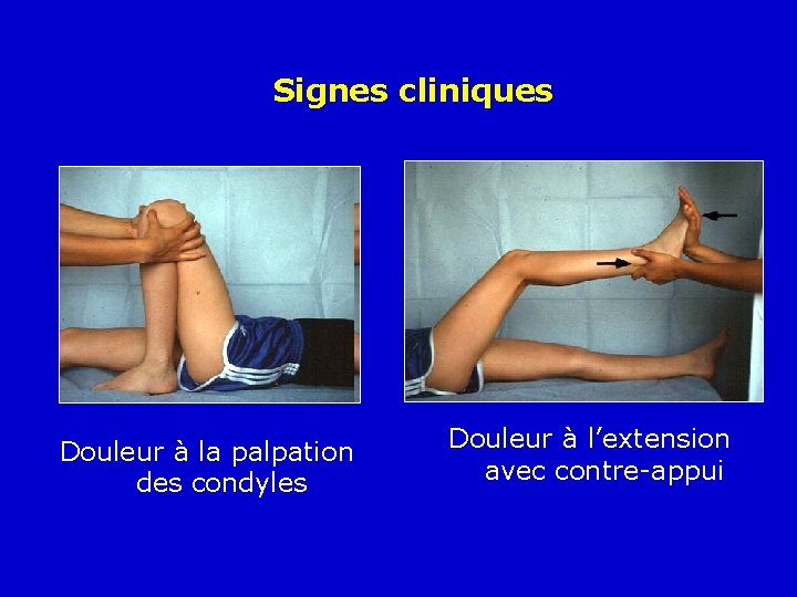 Signes cliniques Douleur à la palpation des condyles Douleur à l’extension avec contre-appui 