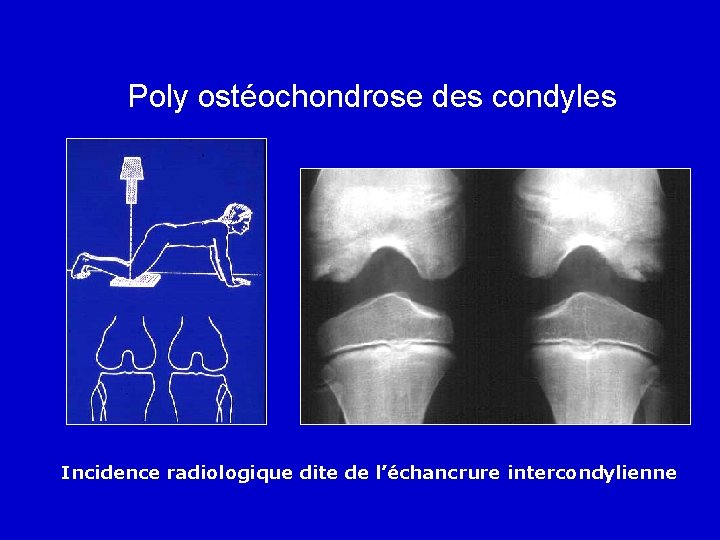 Poly ostéochondrose des condyles Incidence radiologique dite de l’échancrure intercondylienne 