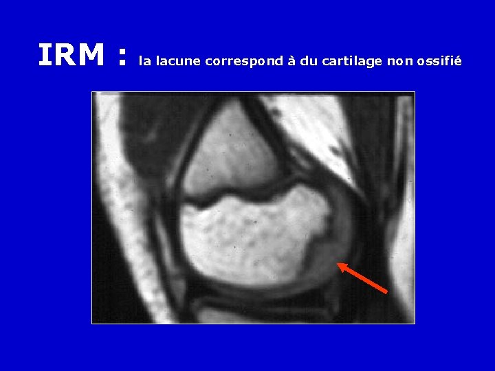 IRM : la lacune correspond à du cartilage non ossifié 