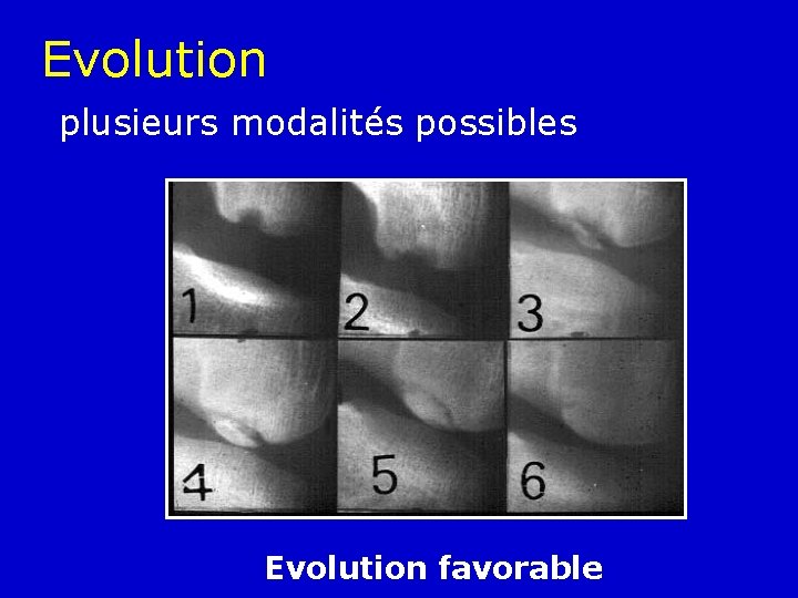 Evolution plusieurs modalités possibles Evolution favorable 