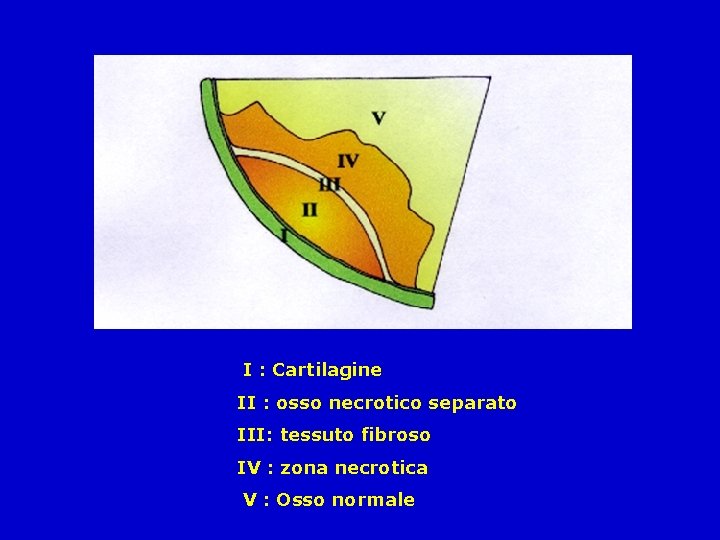 I : Cartilagine II : osso necrotico separato III: tessuto fibroso IV : zona