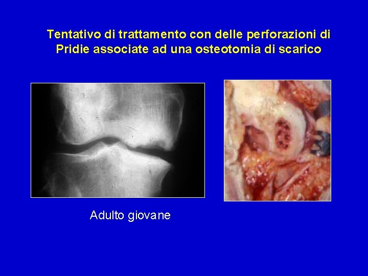 Tentativo di trattamento con delle perforazioni di Pridie associate ad una osteotomia di scarico