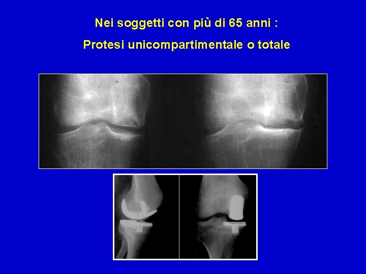 Nei soggetti con più di 65 anni : Protesi unicompartimentale o totale 