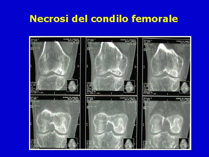 Necrosi del condilo femorale 