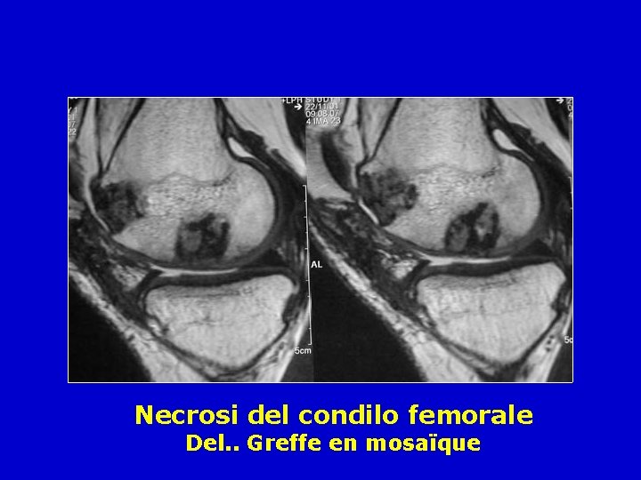 Necrosi del condilo femorale Del. . Greffe en mosaïque 