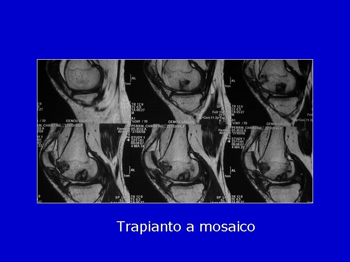 Trapianto a mosaico 