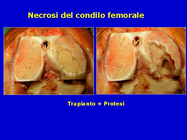 Necrosi del condilo femorale Trapianto + Protesi 