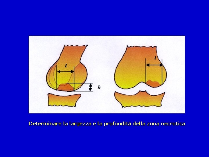 Determinare la largezza e la profondità della zona necrotica 