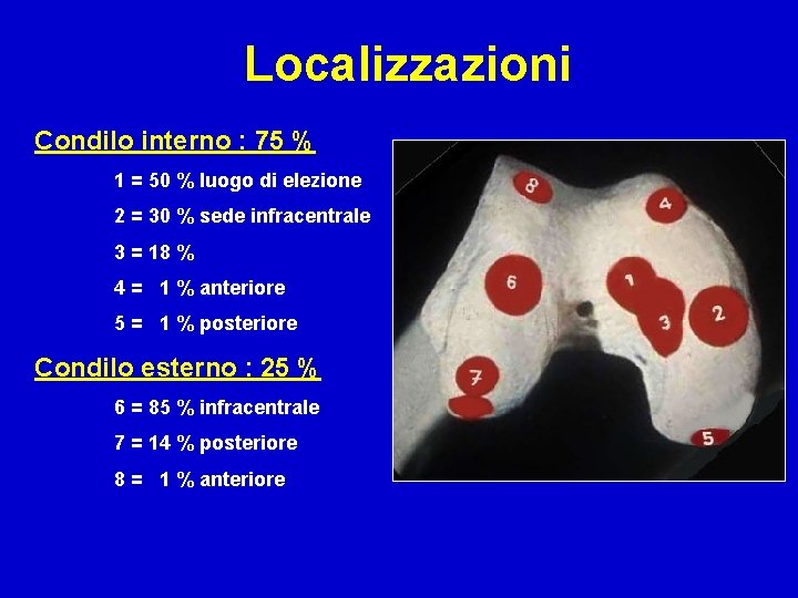 Localizzazioni Condilo interno : 75 % 1 = 50 % luogo di elezione 2