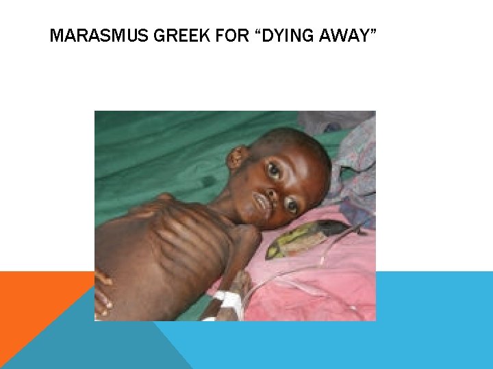 MARASMUS GREEK FOR “DYING AWAY” 