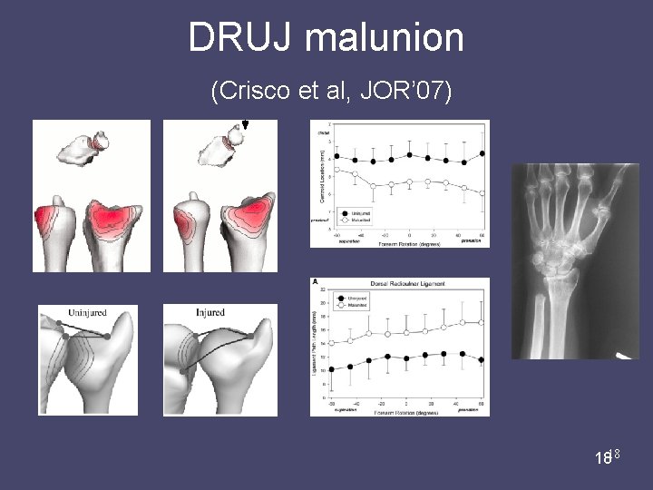 DRUJ malunion (Crisco et al, JOR’ 07) Liz Marai 07/31/08 1818 