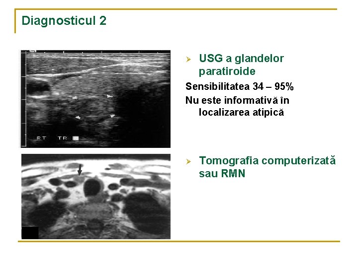 Diagnosticul 2 Ø USG a glandelor paratiroide Sensibilitatea 34 – 95% Nu este informativă Diagnosticul 2 Ø USG a glandelor paratiroide Sensibilitatea 34 – 95% Nu este informativă