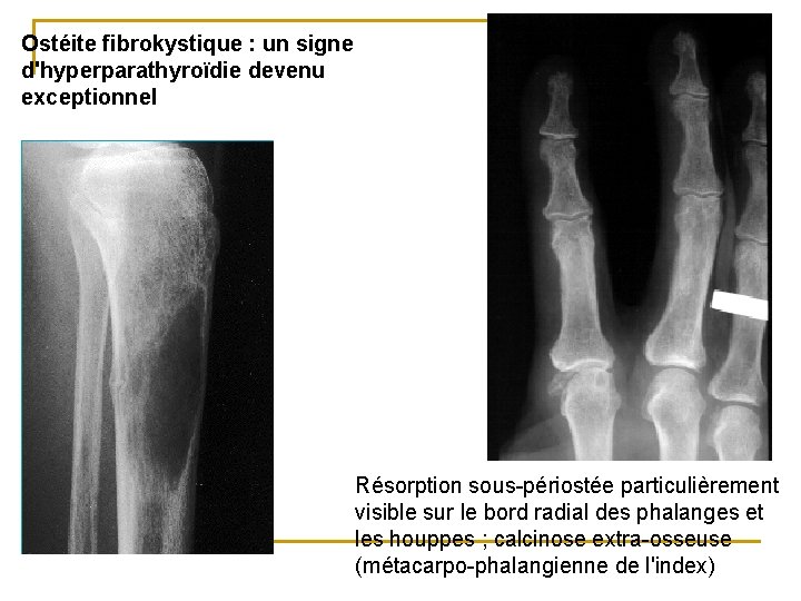 Ostéite fibrokystique : un signe d'hyperparathyroïdie devenu exceptionnel Résorption sous-périostée particulièrement visible sur le