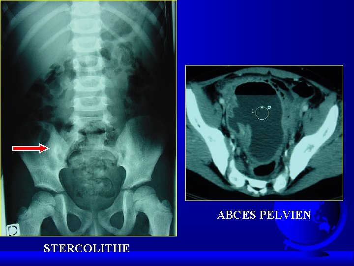 ABCES PELVIEN STERCOLITHE ABCES PELVIEN STERCOLITHE