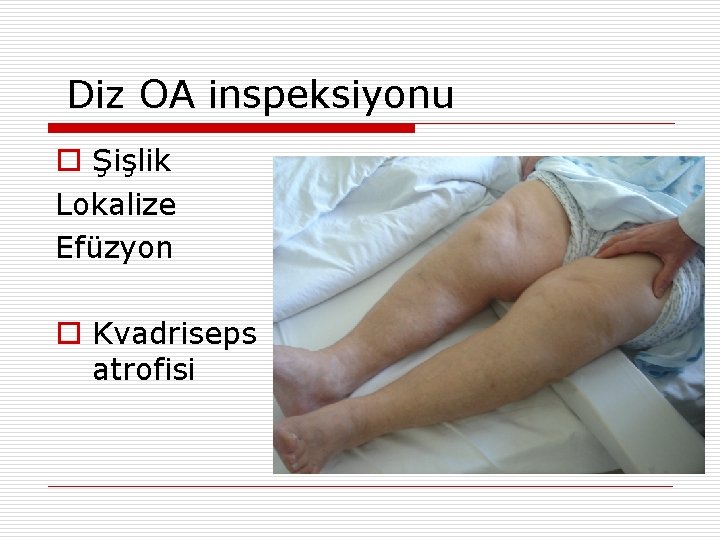 Diz OA inspeksiyonu o Şişlik Lokalize Efüzyon o Kvadriseps atrofisi 