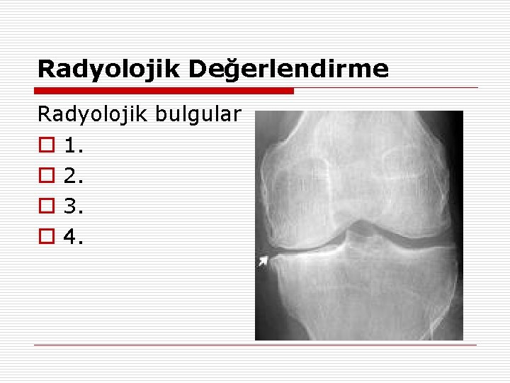 Radyolojik Değerlendirme Radyolojik bulgular o 1. o 2. o 3. o 4. 