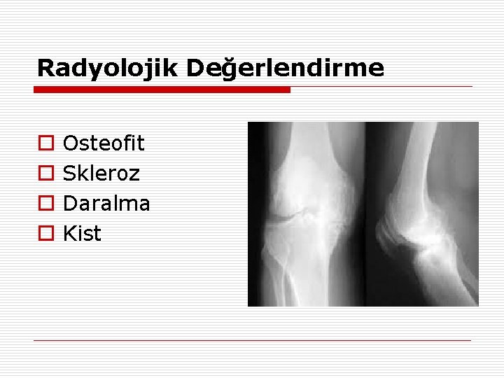 Radyolojik Değerlendirme o o Osteofit Skleroz Daralma Kist 