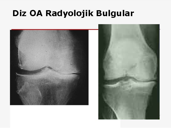 Diz OA Radyolojik Bulgular 