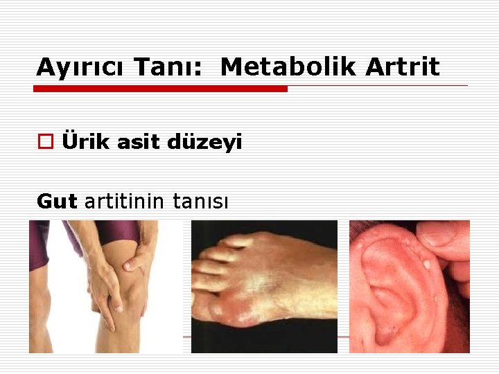 Ayırıcı Tanı: Metabolik Artrit o Ürik asit düzeyi Gut artitinin tanısı 