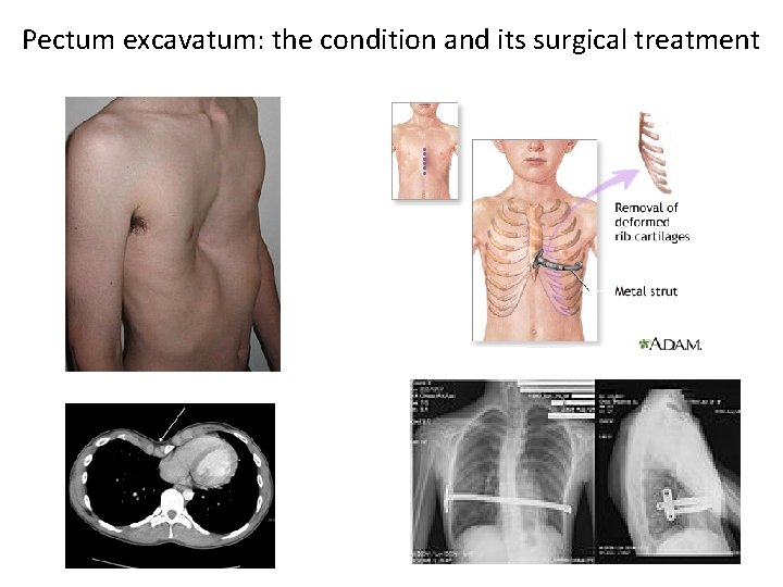 Pectum excavatum: the condition and its surgical treatment 