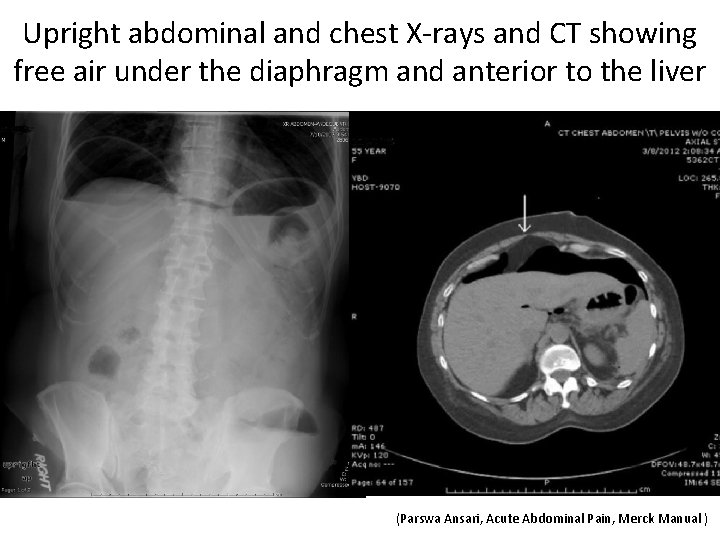 Upright abdominal and chest X-rays and CT showing free air under the diaphragm and