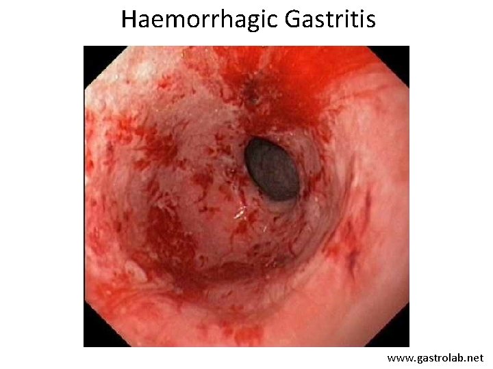 Haemorrhagic Gastritis www. gastrolab. net 