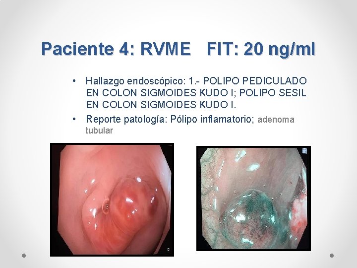 Paciente 4: RVME FIT: 20 ng/ml • Hallazgo endoscópico: 1. - POLIPO PEDICULADO EN